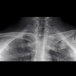 Fractured Clavicle treated at OrthoNOW