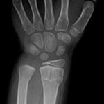 Wrist Radial Fracture treated at OrthoNOW