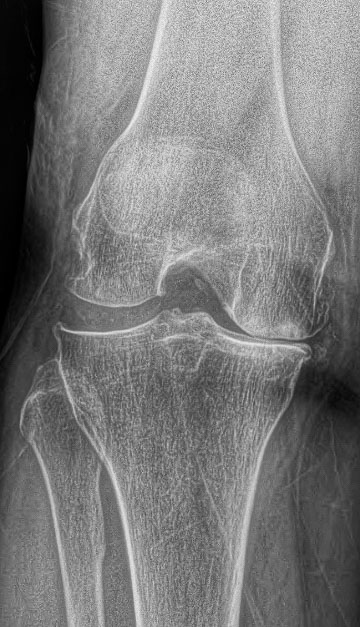OrthoNOW treats Chronic Knee pain