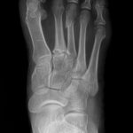 Foot X-ray at OrthoNOW