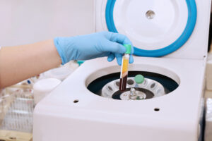 Medical tube with blood plasma in hand for PRP, extracted from medical centrifuge for plasma lifting